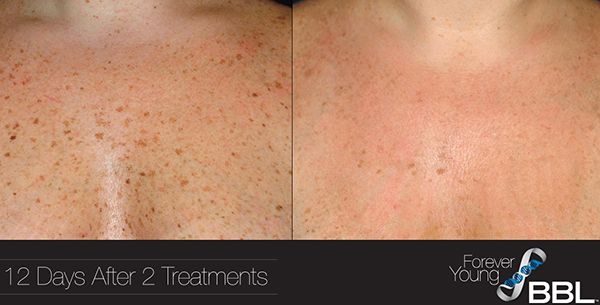 BBL Treatments Before and After, Richmond, VA