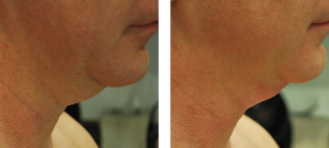 MiniFX Before & After MiniFX Before & After