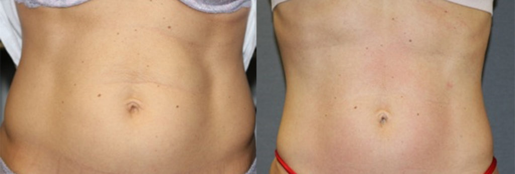 BodyFX Before & After BodyFX Before & After