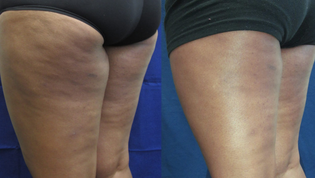 BodyFX Before & After Result BodyFX Before & After Result