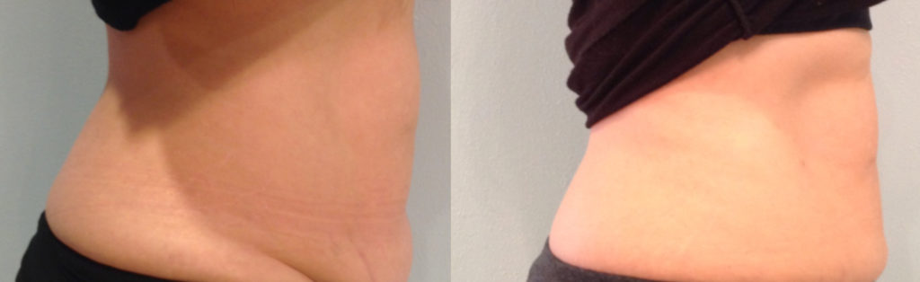 BodyFX Before & After Result BodyFX Before & After Result