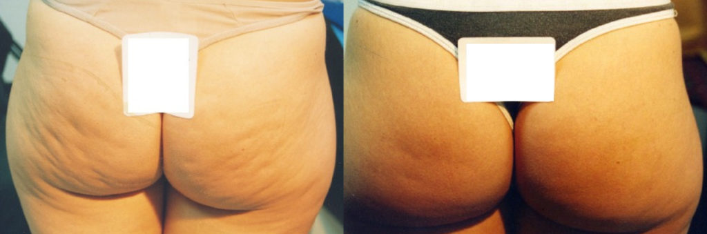 BodyFX Before & After Result BodyFX Before & After Result