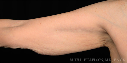 Before Thermage - Body Contouring photo