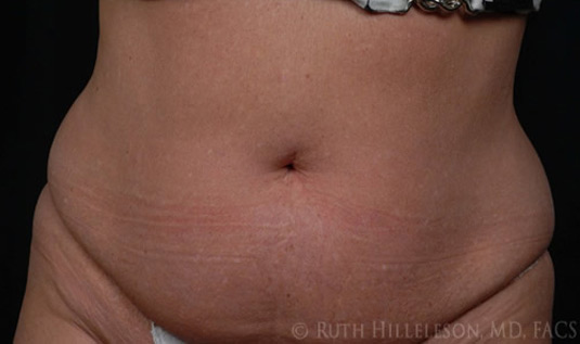 Before CoolSculpting photo
