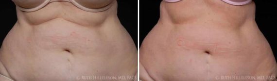 CoolSculpting Before and After Photos in Richmond, VA
