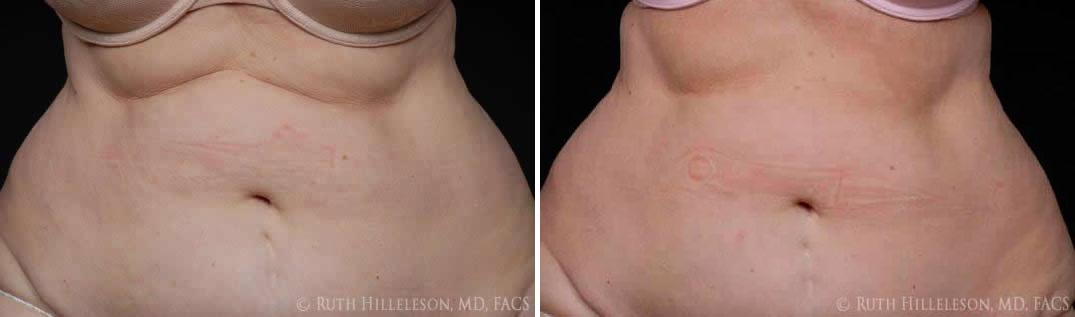 CoolSculpting Before and After Photos in Richmond, VA, Patient 5013