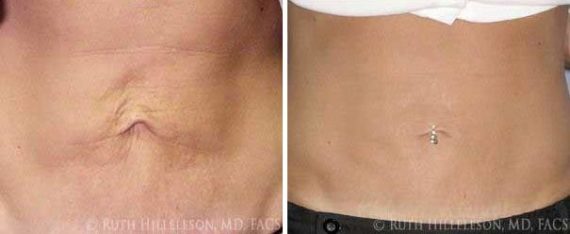 Thermage - Body Contouring Before and After Photos in Richmond, VA