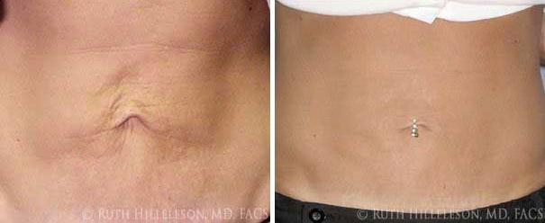 Thermage - Body Contouring Before and After Photos in Richmond, VA, Patient 5100