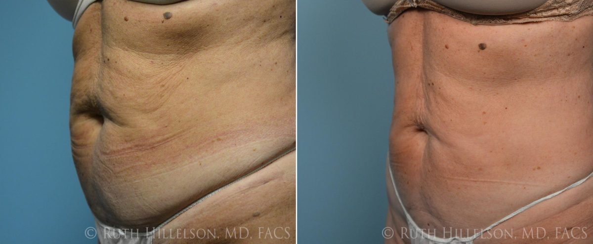 Thermage - Body Contouring Before and After Photos in Richmond, VA, Patient 5108