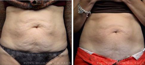 Thermage - Body Contouring Before and After Photos in Richmond, VA, Patient 5088