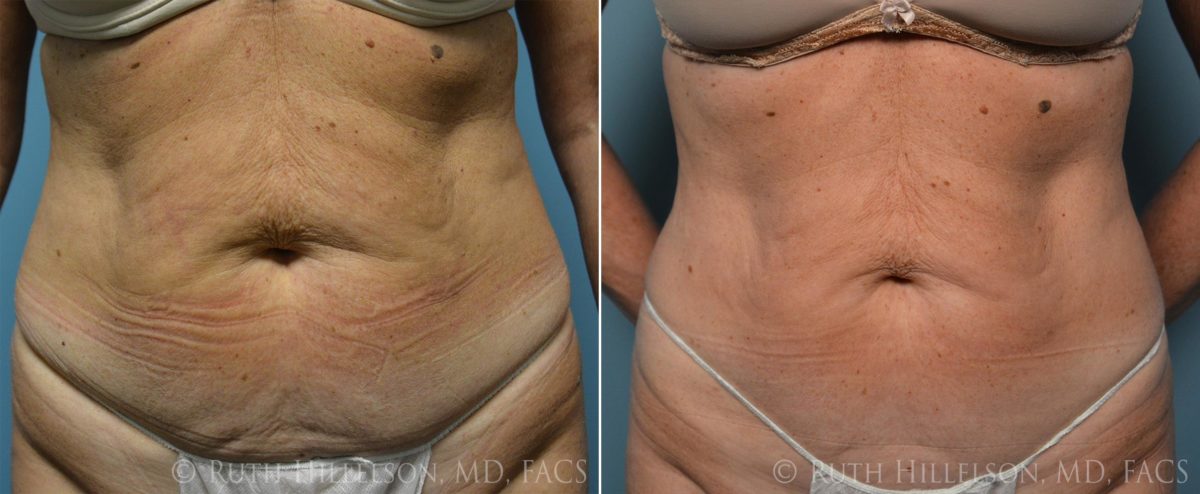 Thermage - Body Contouring Before and After Photos in Richmond, VA, Patient 5108