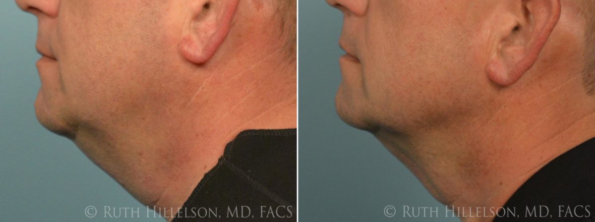 Thermage - Skin Tightening Before and After Photos in Richmond, VA, Patient 5060