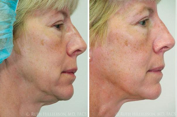 Thermage - Skin Tightening Before and After Photos in Richmond, VA, Patient 5021