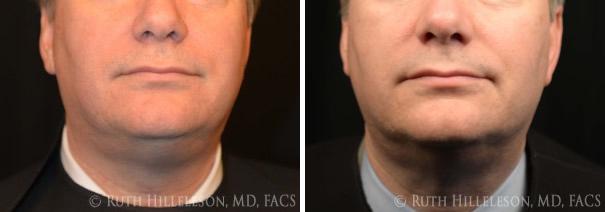 Thermage - Skin Tightening Before and After Photos in Richmond, VA, Patient 5028