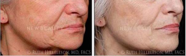 Thermage - Skin Tightening Before and After Photos in Richmond, VA, Patient 5035