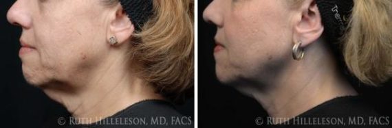Thermage - Skin Tightening Before and After Photos in Richmond, VA