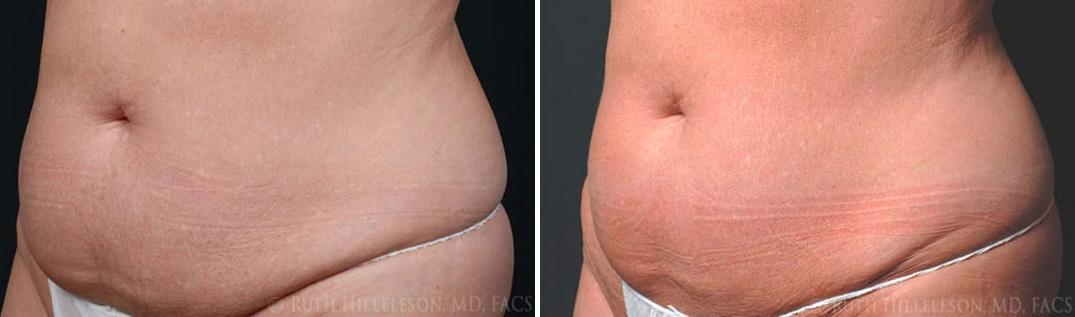 CoolSculpting Before and After Photos in Richmond, VA, Patient 5006