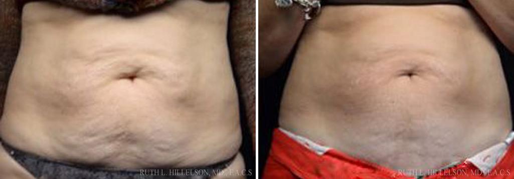 TriPollar RF Before and After Photos in Richmond, VA, Patient 5132