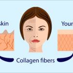 What is Collagen Remodeling?