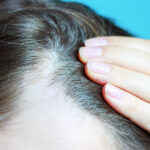 3 Non Surgical Hair Loss Treatments