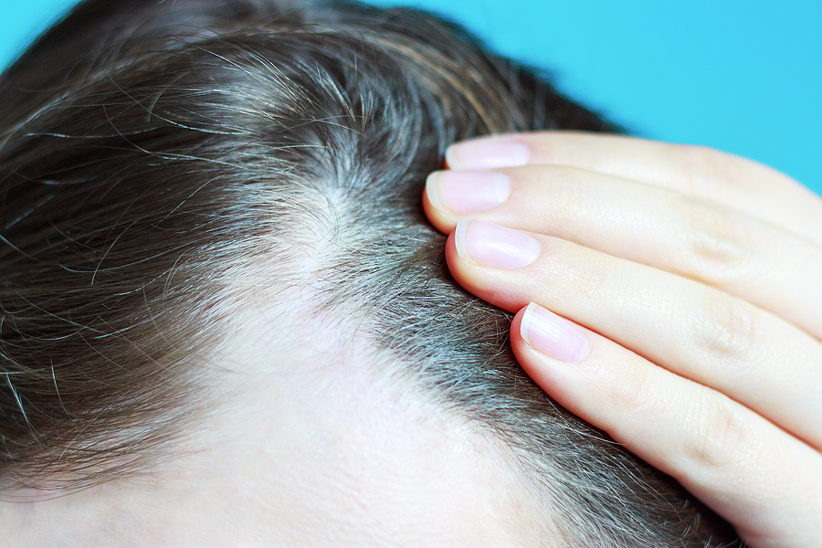 Non Surgical Treatments for Hair Loss