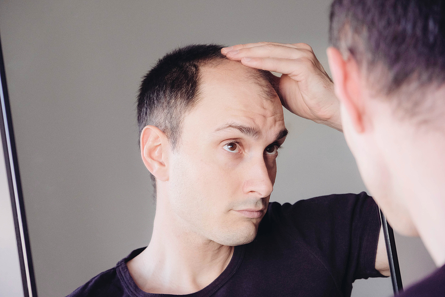 Does PRP Work for Frontal Hair Loss