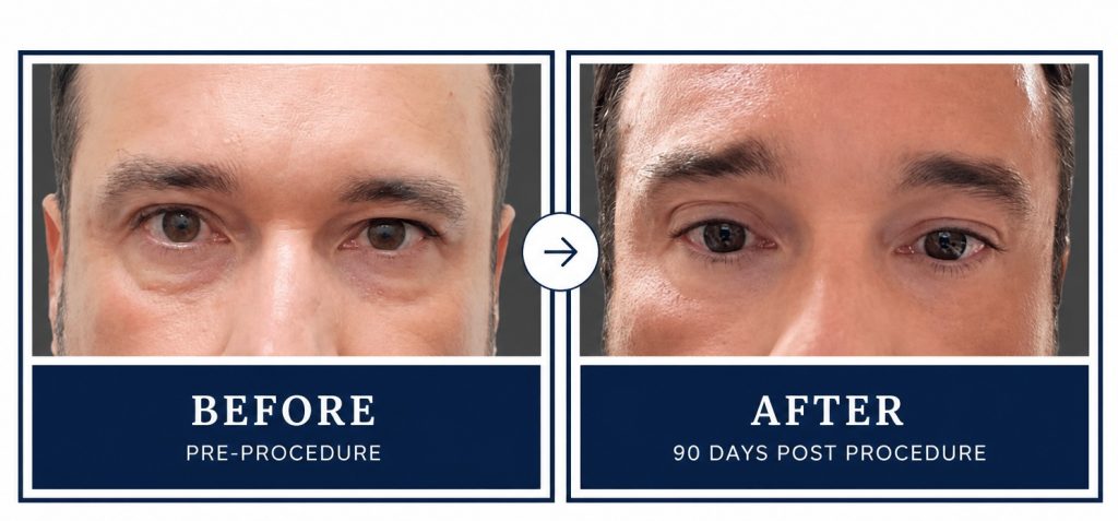 Before & After Tixel Treatment of Men Tixel Skin Rejuvenation